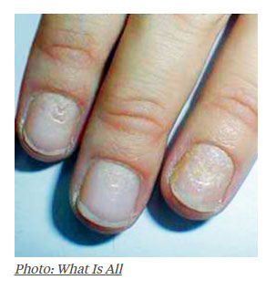 unha corros&atilde;o