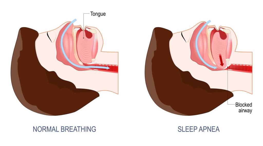 Obstructive Sleep Apnea.