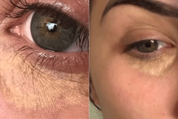 CAMUFLAGEM DE OLHEIRAS O procedimento na influencer Joyce Ferreira não saiu como esperado