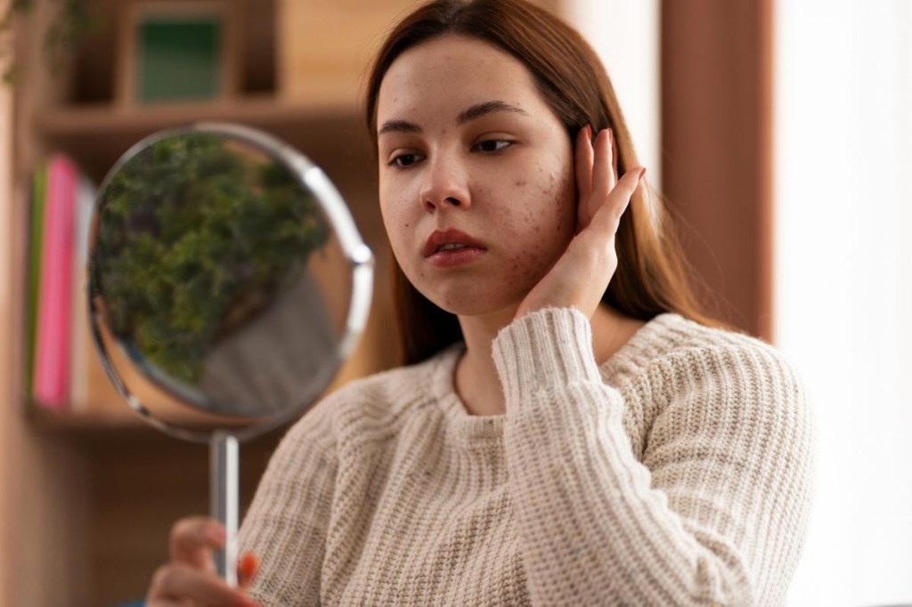 O impacto da acne na depressão: entenda como a condição afeta o bem-estar