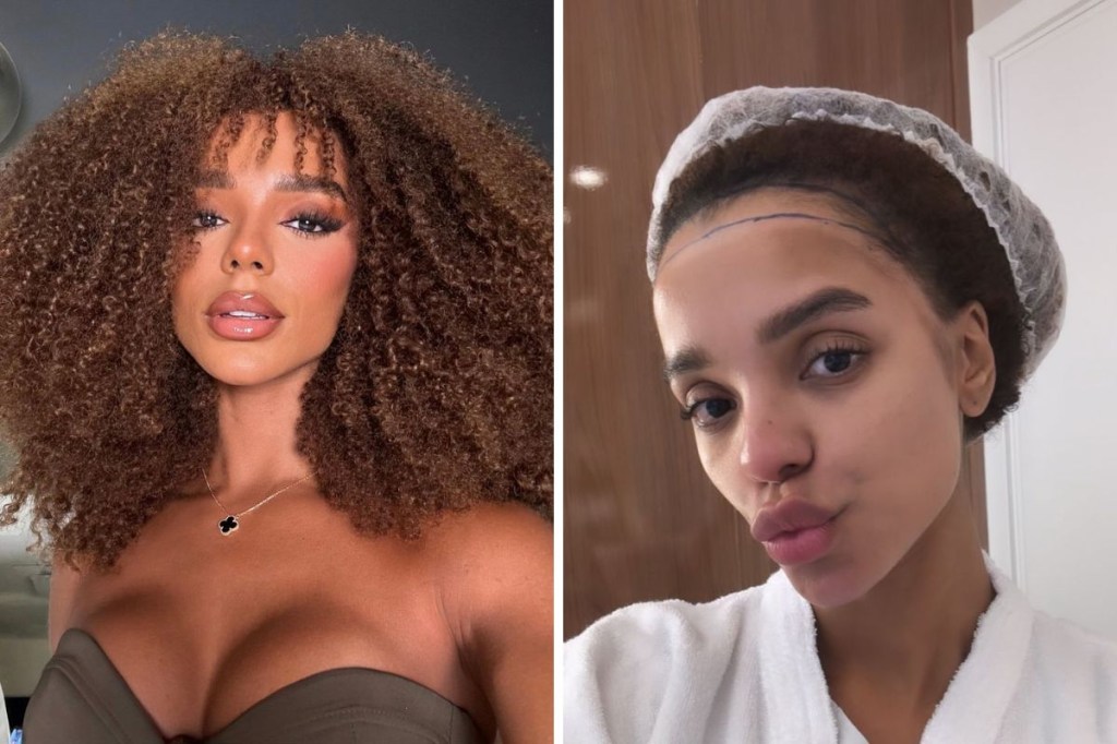 O que é a frontoplastia, cirurgia feita por Brunna Gonçalves?