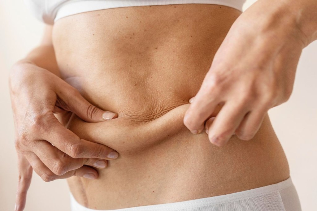 Lipoaspiração pode deixar a pele flácida?