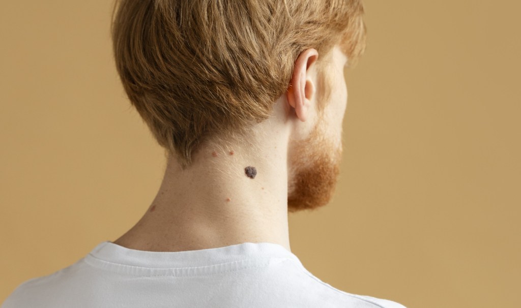 Proteja a saúde: saiba como usar a regra ‘ABCDE’ no autoexame de melanoma