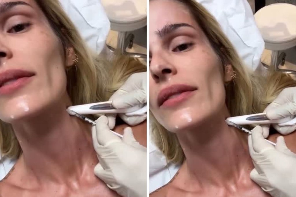 botox nefertiti yasmin brunet botox nefertiti yasmin brunet