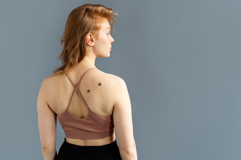 Junho Preto: tudo que você precisa saber sobre o melanoma e como se proteger